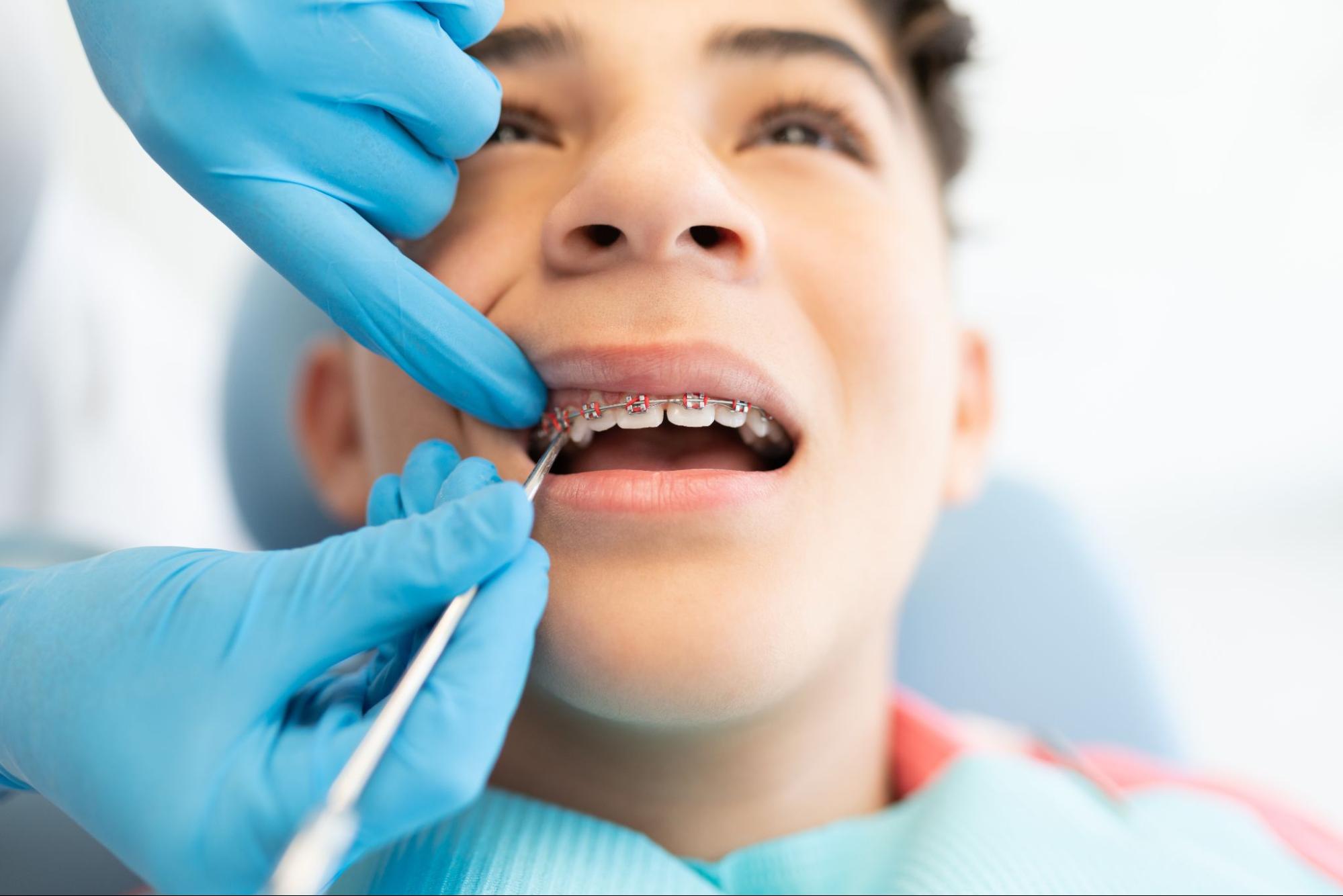 The Purpose of Orthodontic Bands and Elastics in Orthodontics