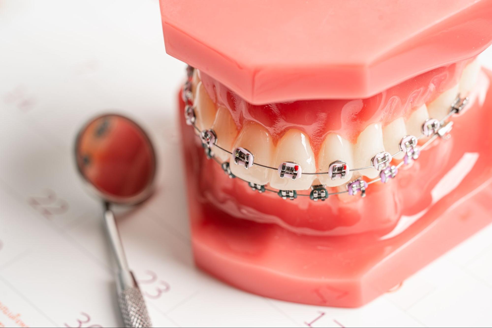 What Can I Do to Stay on Schedule with My Orthodontic Treatment?