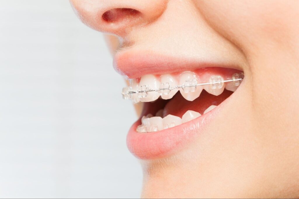 Orthodontic Treatment Options for Busy Professionals