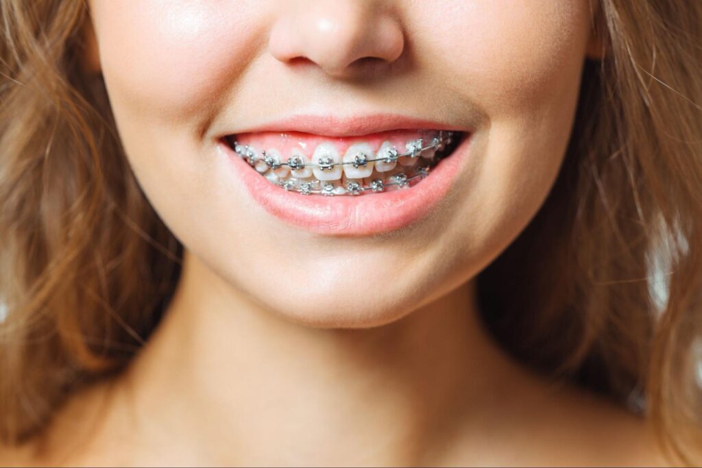 How To Stop Mouth Pain After Adjusting Your Braces