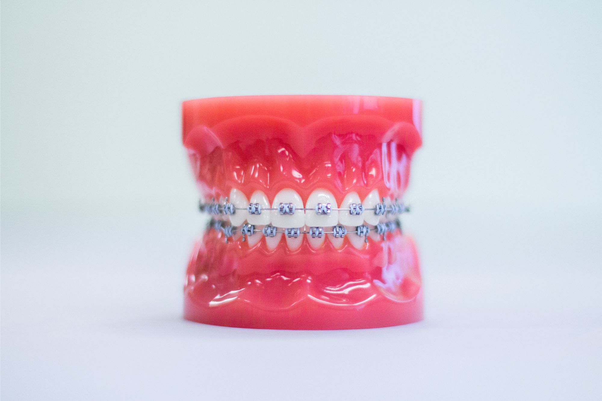 Metal braces model for orthodontics in Kansas City